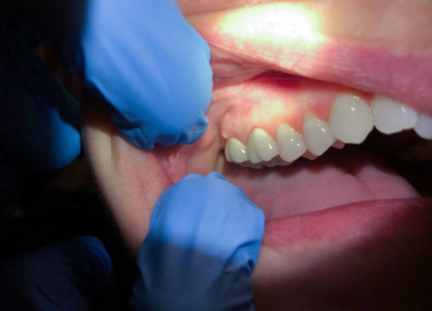 Best Emergency Dental Care for Broken or Chipped Teeth in Natchitoches, LA